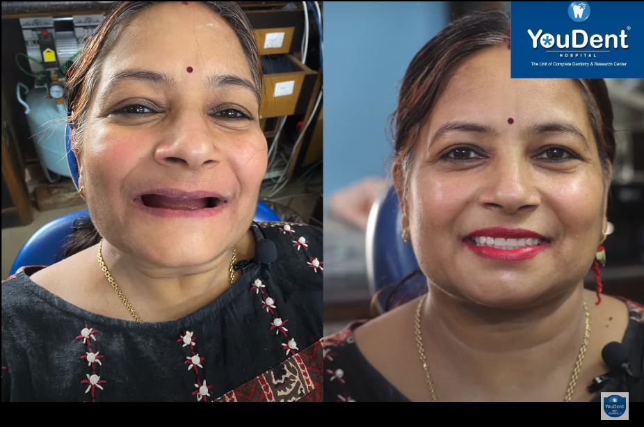 How Dental Implants Can Transform Your Smile and Confidence